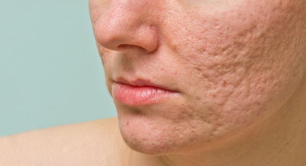 Acne, un disturbo multifattoriale... i Rimedi ?