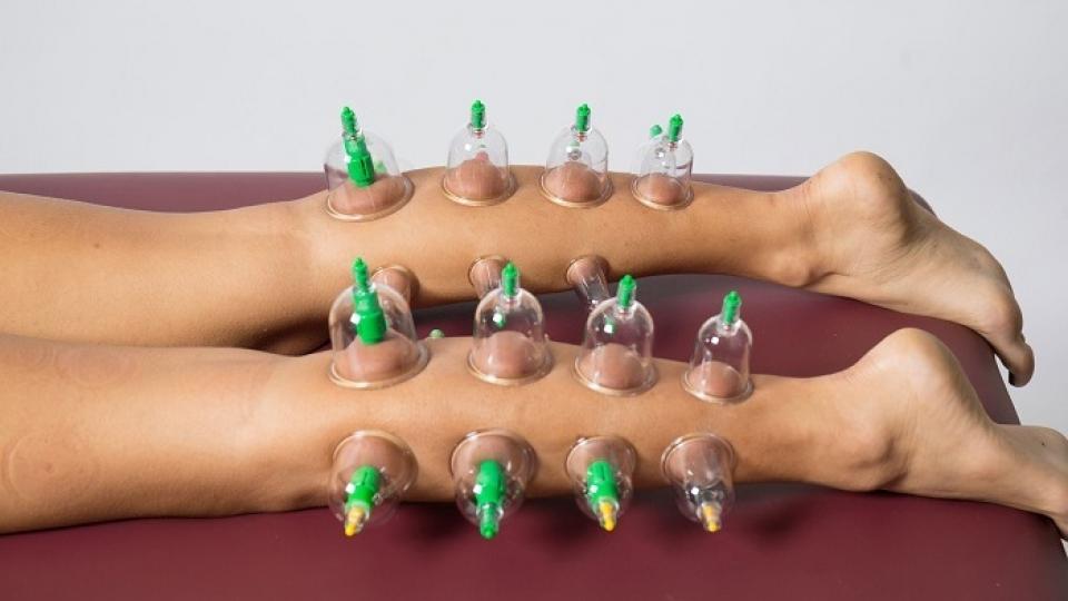 Coppettazione o CUPPING MASSAGE Medicina Alternativa