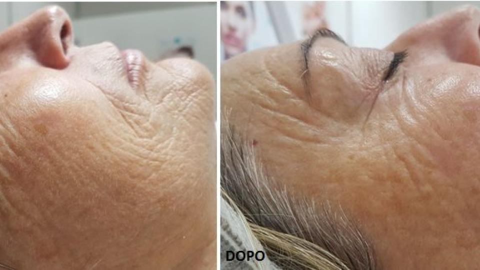 BIOSTIMOLAZIONE di Collagene Cos’è ?